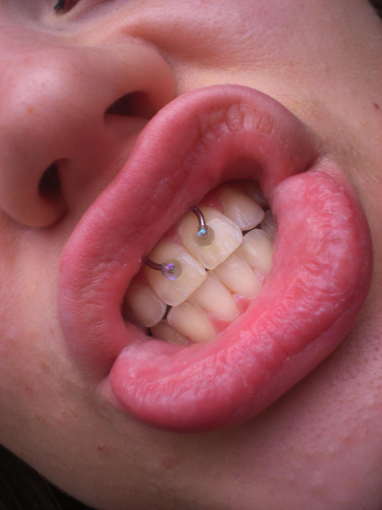 Infected Lip Piercing, Pictures, Infant, How to Clean ...